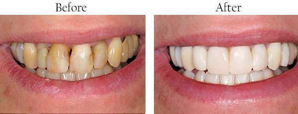 Union Before and After Dental Implants