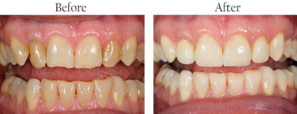 Springfield Township Before and After Teeth Whitening