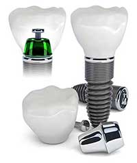 Union Dental Implants