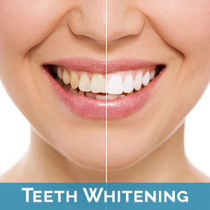 Roselle Park Teeth Whitening