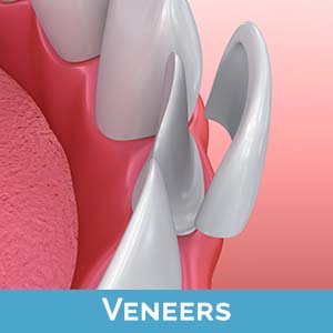 Veneers in Union